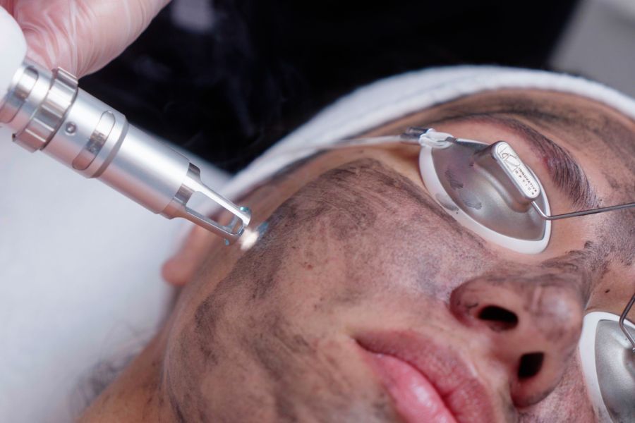 Close-up of a carbon correcting facial treatment being performed on a woman's face with laser device
