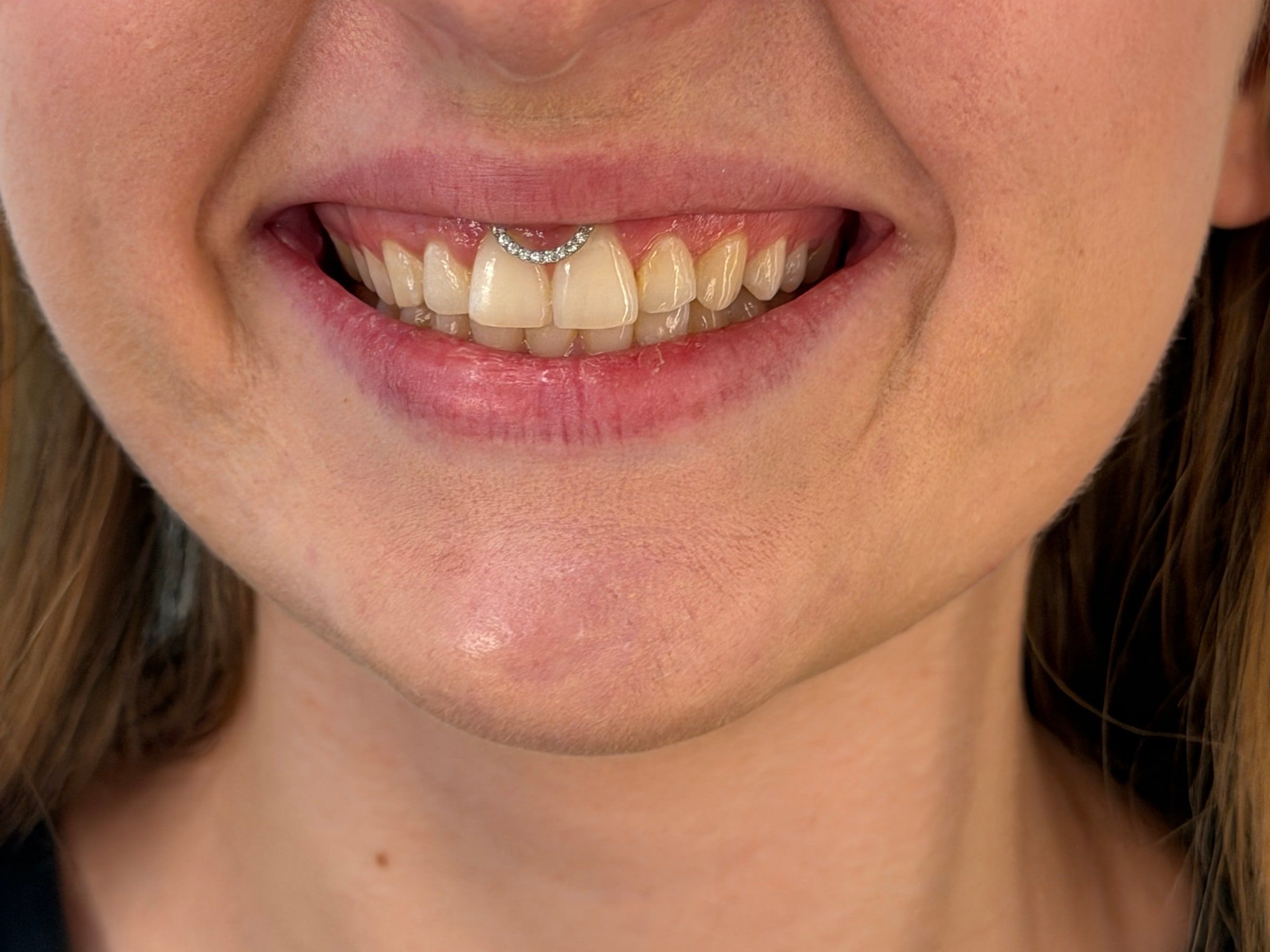 Smiley piercing zblízka