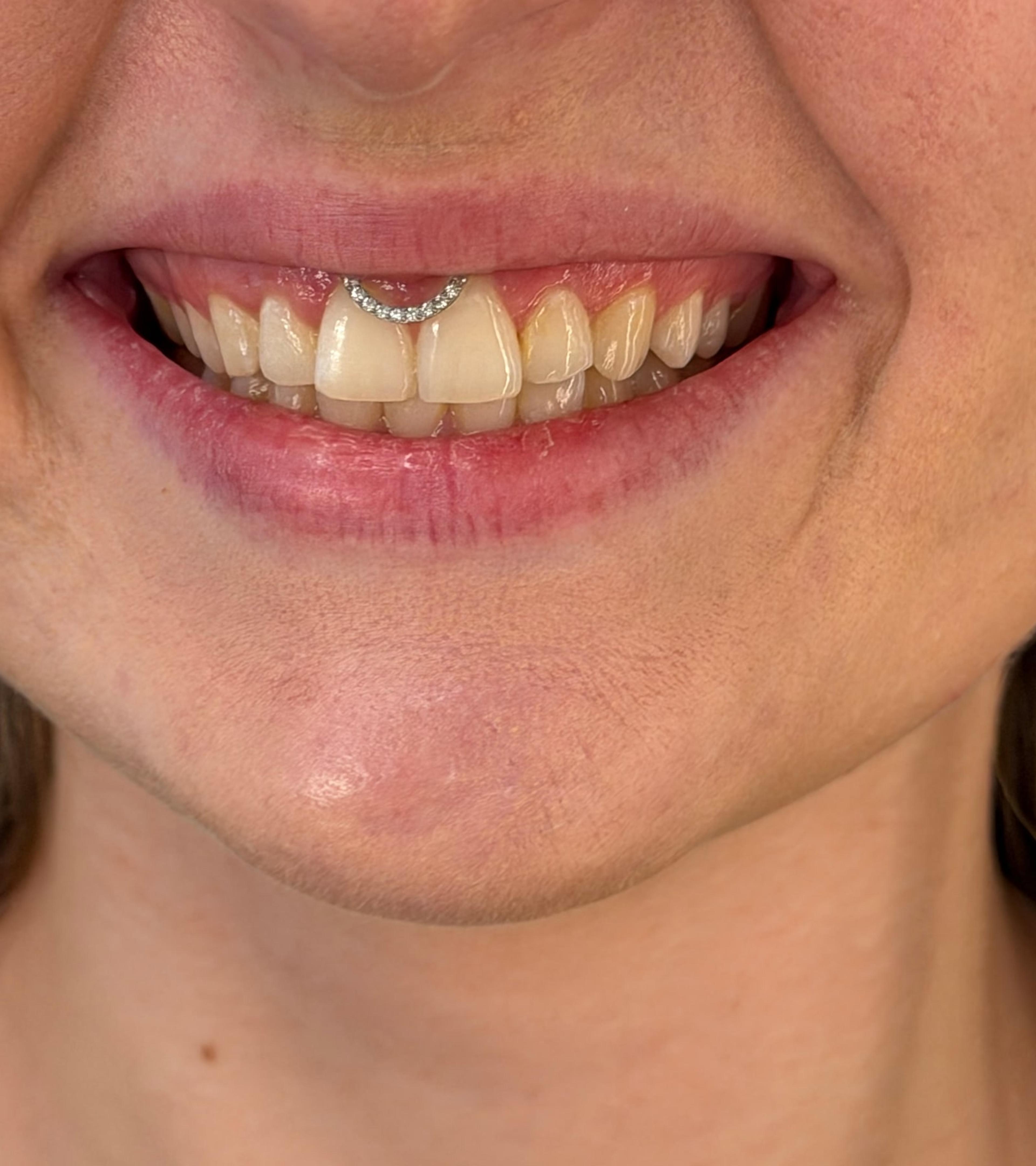 Smiley piercing zblízka