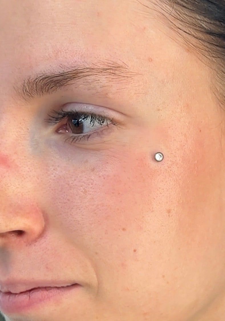 Microdermal