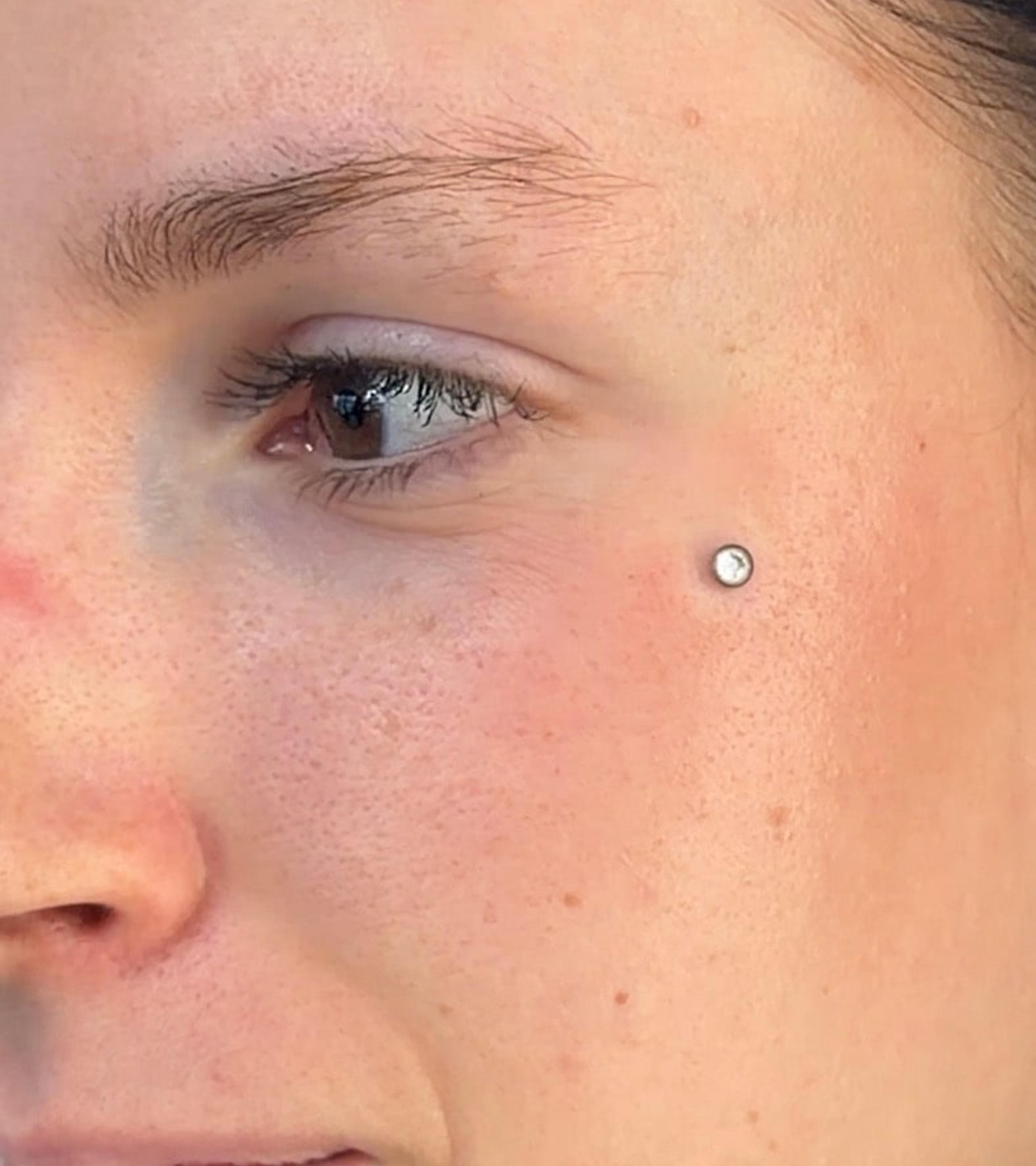 Microdermal