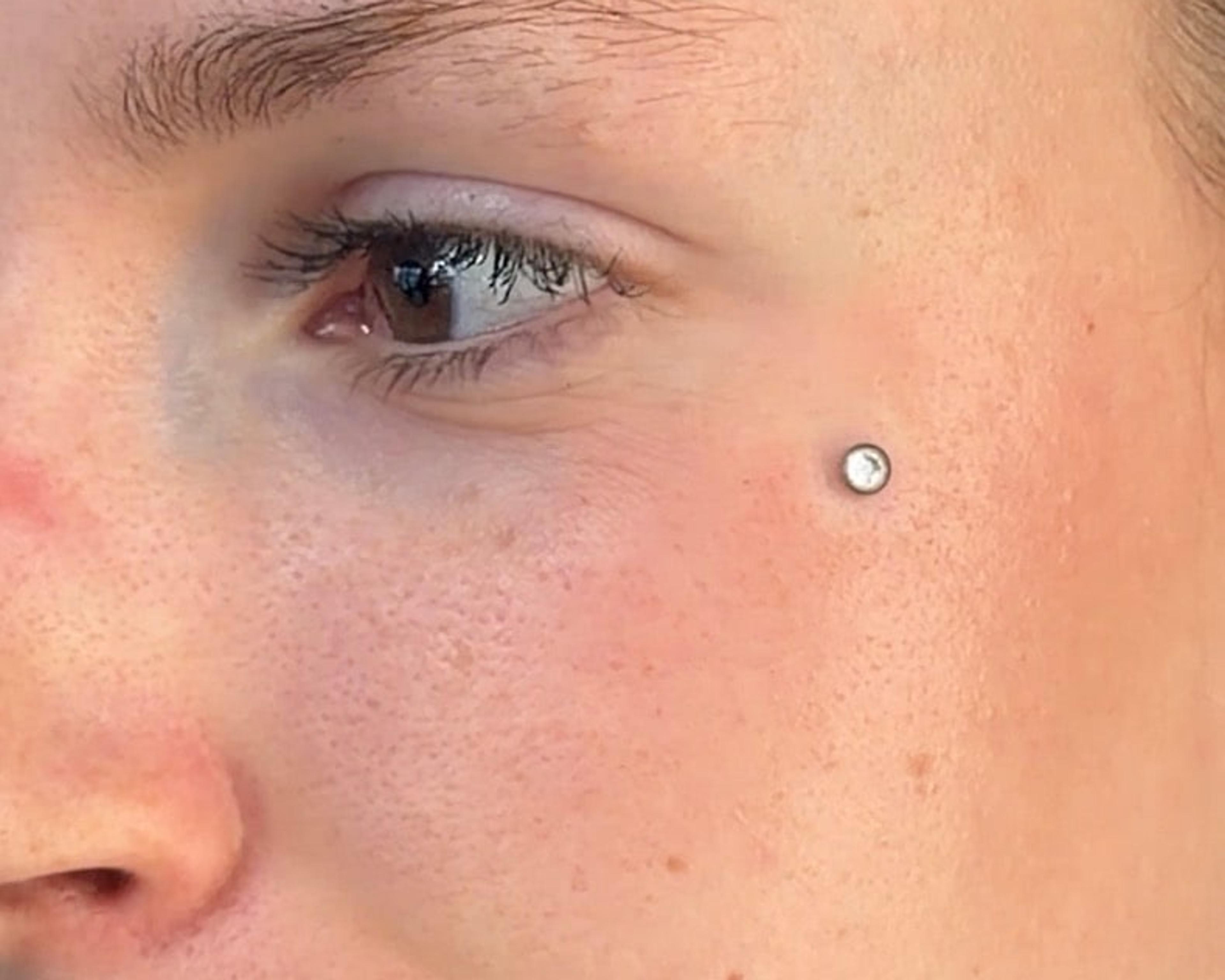 Microdermal