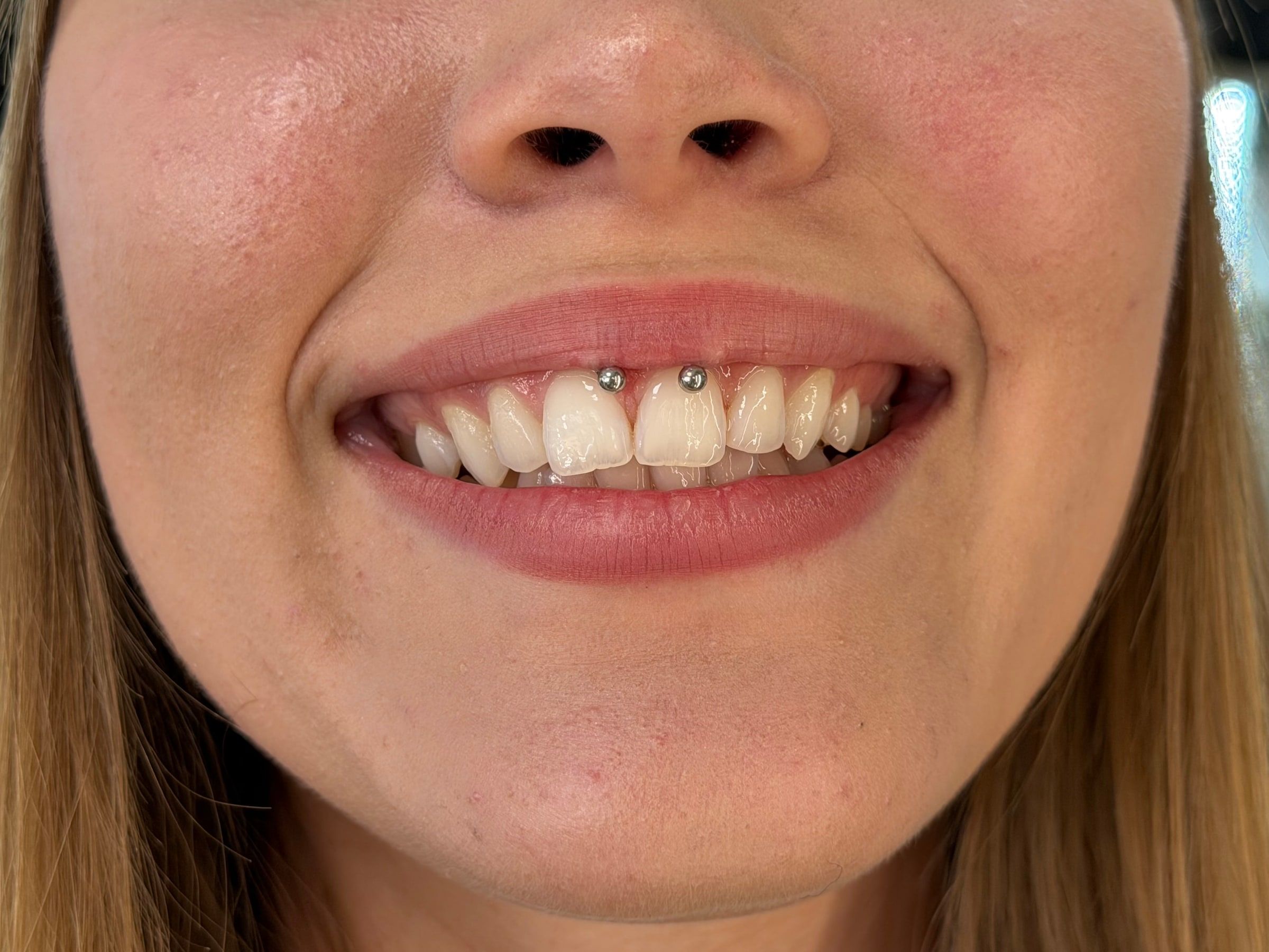 Smiley piercing