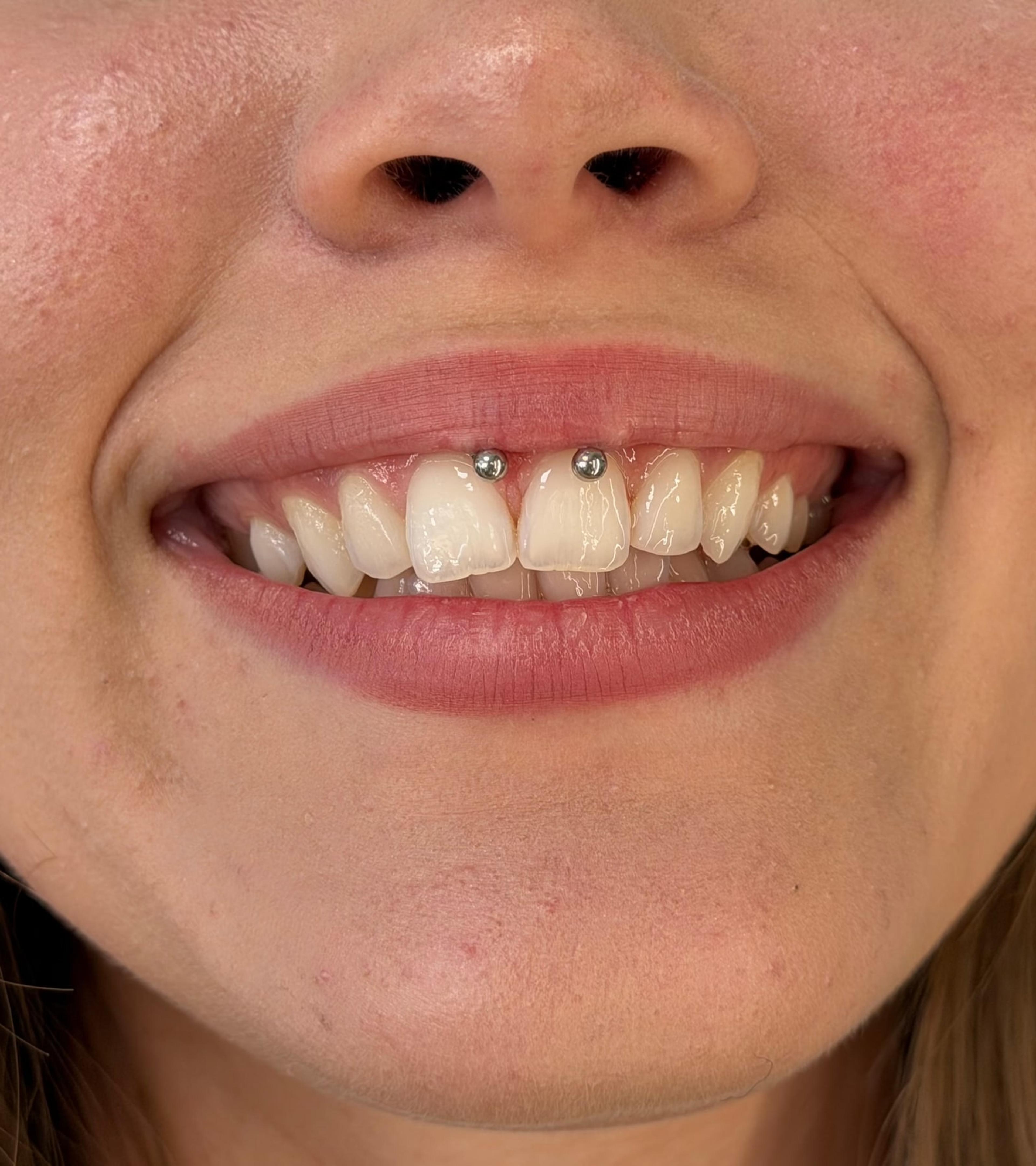 Smiley piercing