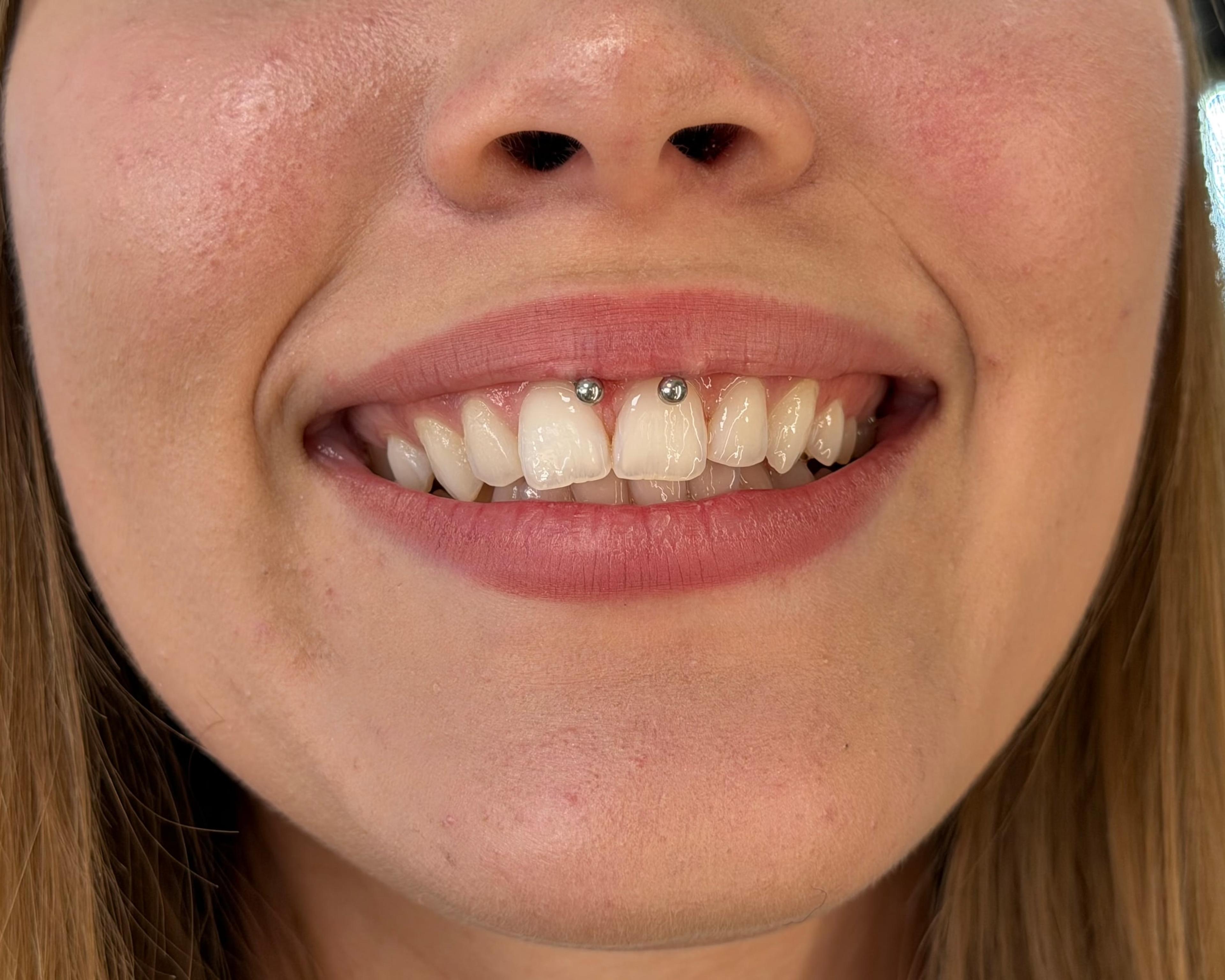 Smiley piercing