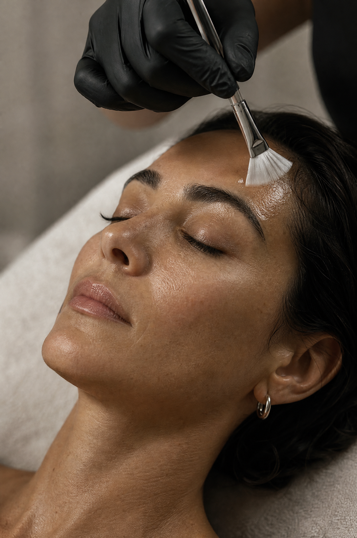 Chemical Peel