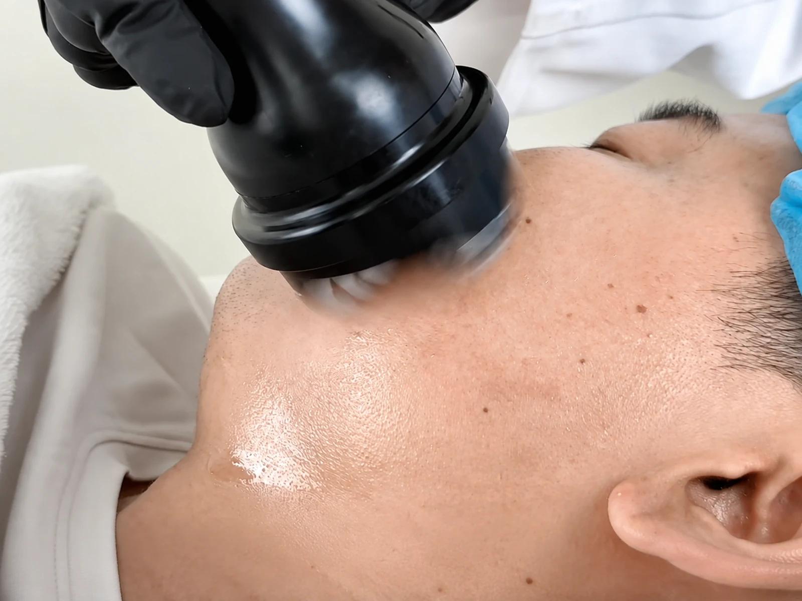Dedicated LX-CB-002 facial handpiece in direct contact with the cheek during treatment