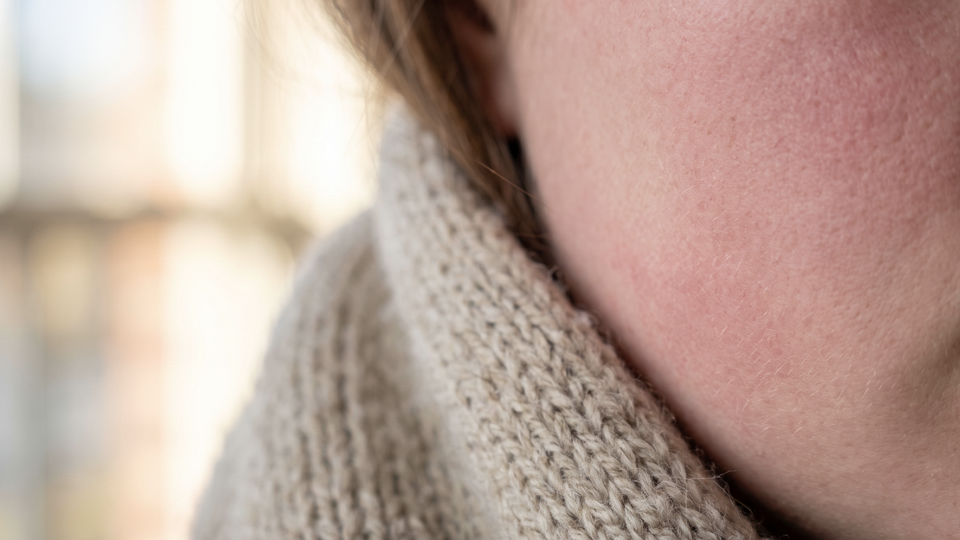 Redness spread evenly from the cheek to the jawline after being out in cold wind