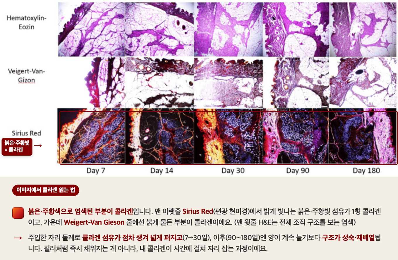폴리엘락틱산(PLLA) 콜라겐 자극제를 주입한 피부 조직을 7, 14, 30, 90, 180일차에 채취한 조직학 사진 - 맨 아랫줄 Sirius Red 염색에서 붉은·주황빛으로 빛나는 부분이 새로 생긴 콜라겐이며, 주입 부위 둘레로 콜라겐이 점차 생겨 퍼진다