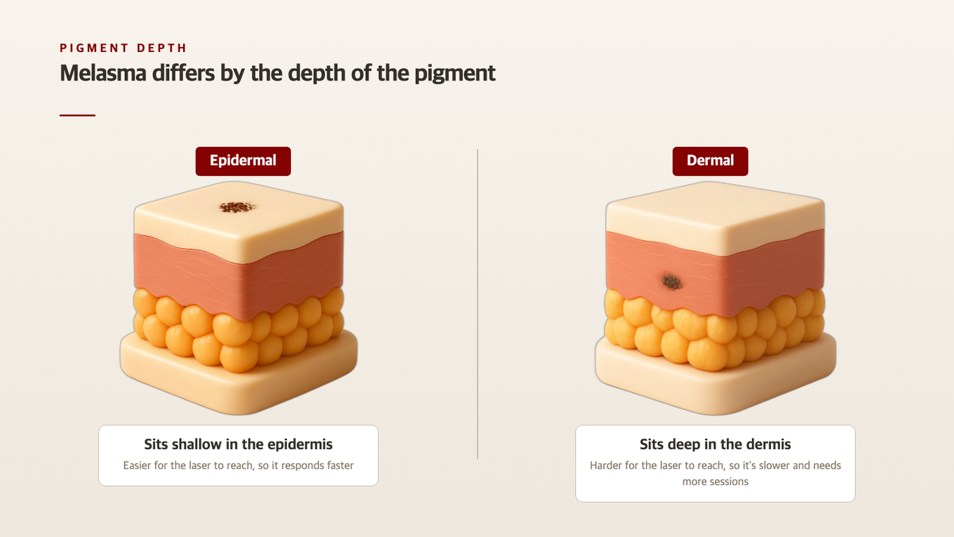 Diagram showing pigment locations in epidermal vs dermal pigmentation