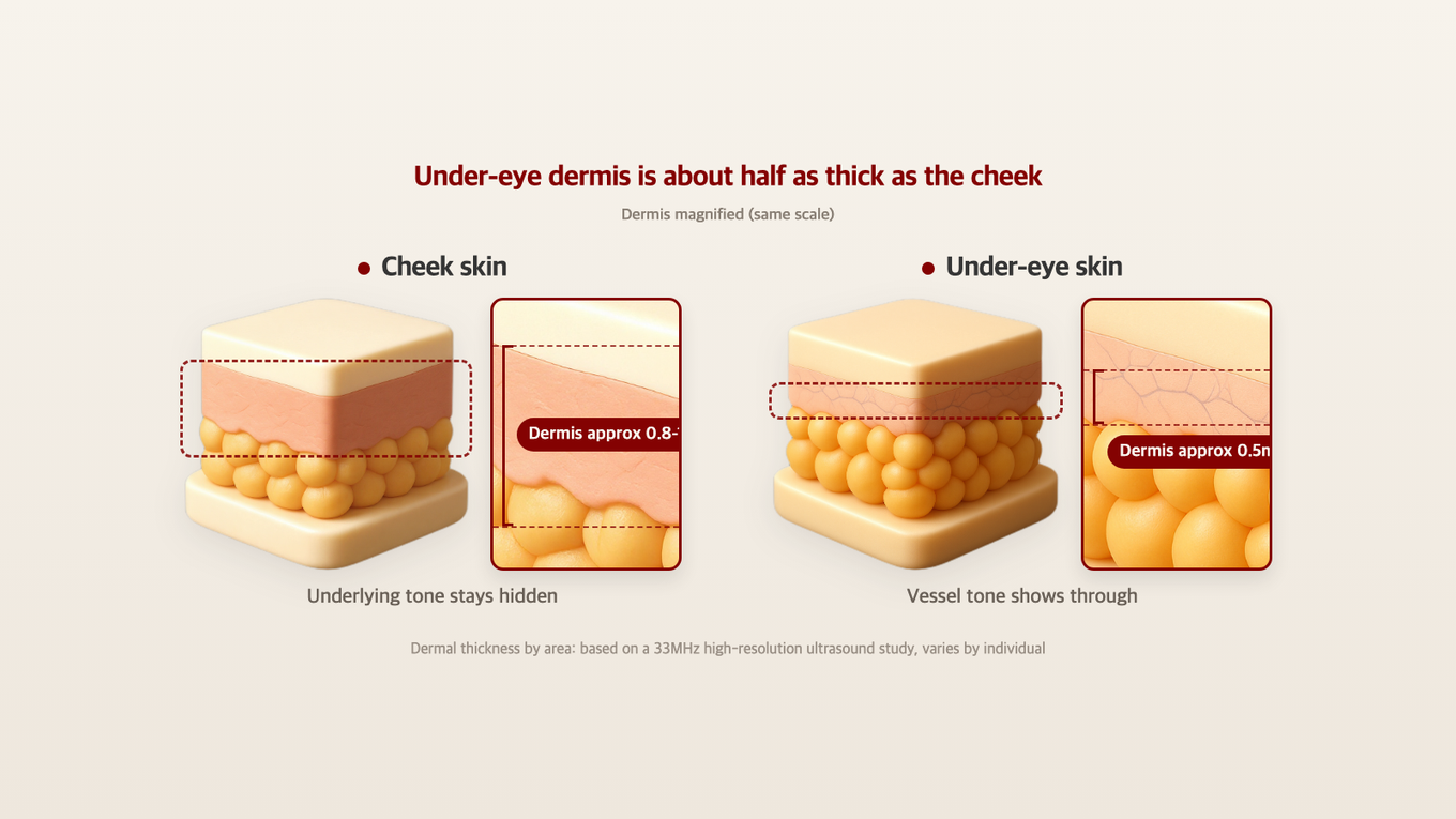 Comparison of dermal thickness in cheek and under-eye skin models - cheeks hide underlying tones better, under-eye shows vascular tones due to thinner skin