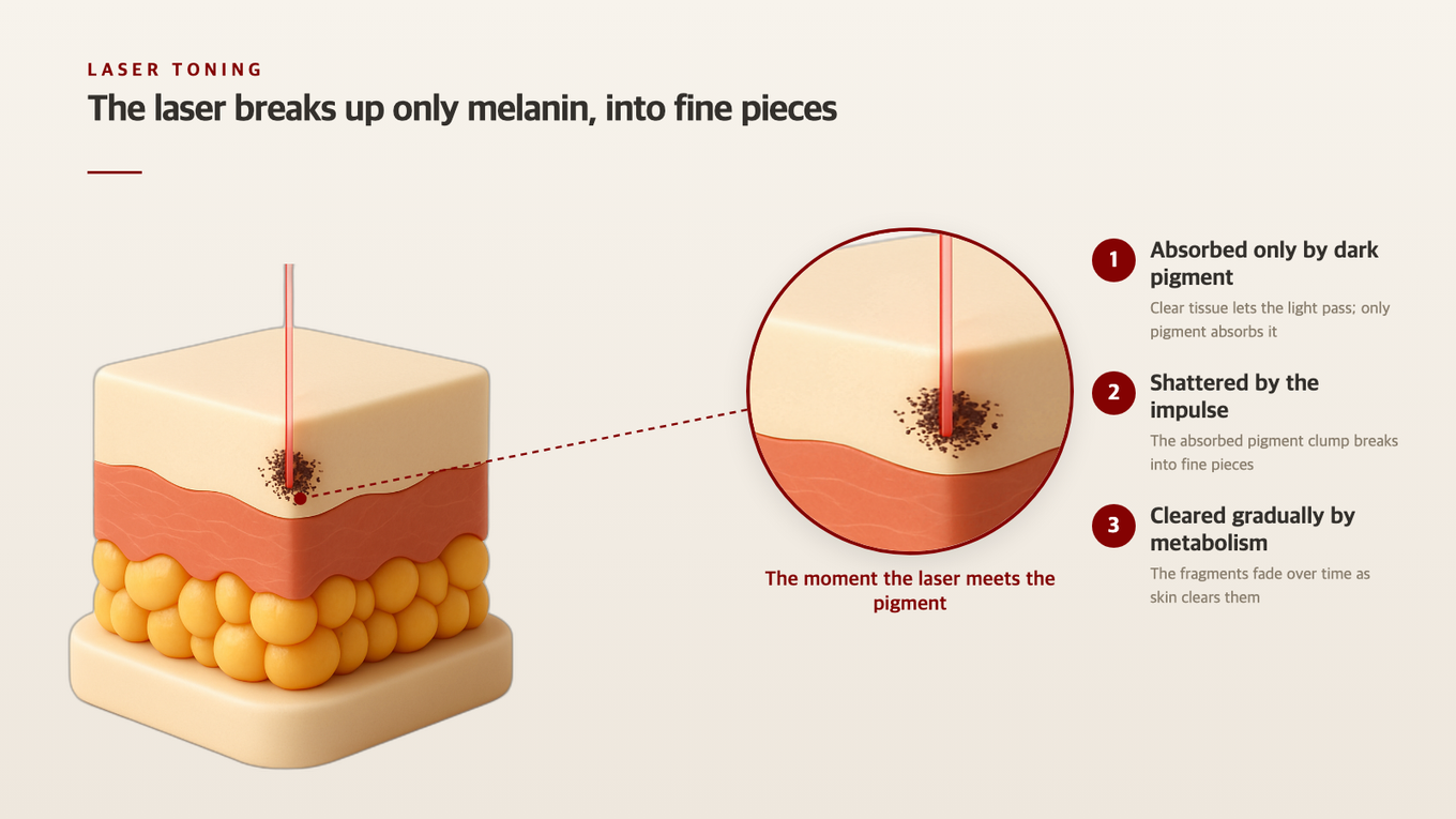 Realistic 3D model depicting laser breaking down melanin pigment