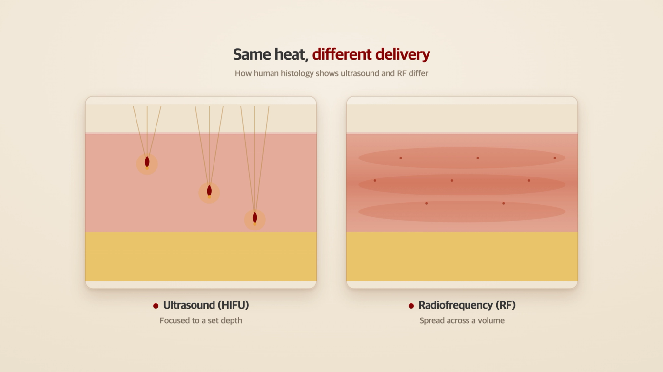 Ultrasound delivers heat focused to a set depth while radiofrequency spreads it across several dermal layers