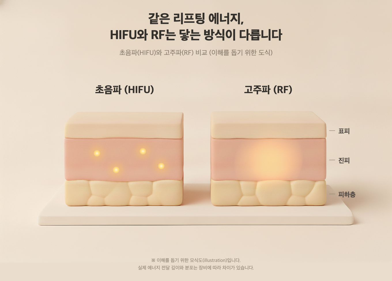 HIFU는 에너지를 한 점에 모아 깊은 층까지 전달하고, RF는 면으로 넓게 퍼뜨려 진피를 고르게 데운다