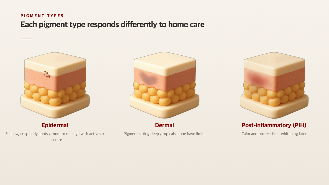 Epidermal shows as shallow brown spots, dermal as deep spread-out pigment, and PIH appears with redness - each type expects something different from home care