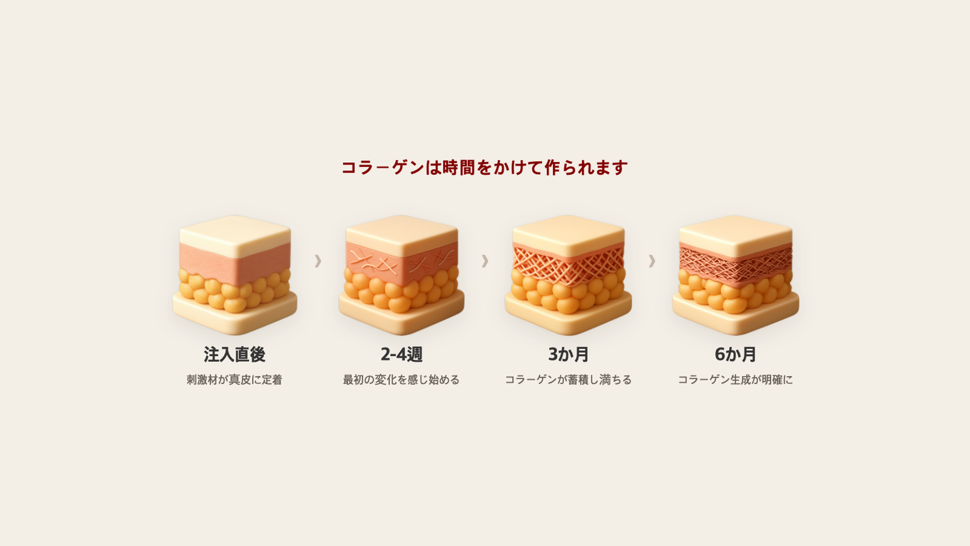 注入直後から6か月まで、コラーゲンが時間をかけて段階的に満ちていく真皮断面の4段階