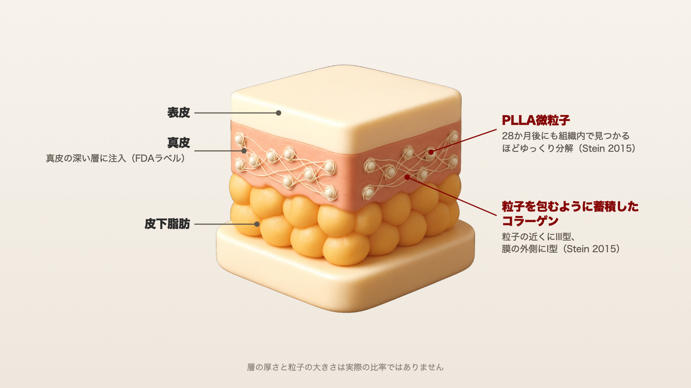 真皮の深い層にあるPLLA微粒子の周りを、新しいコラーゲン線維が取り囲みながら編み込まれていく