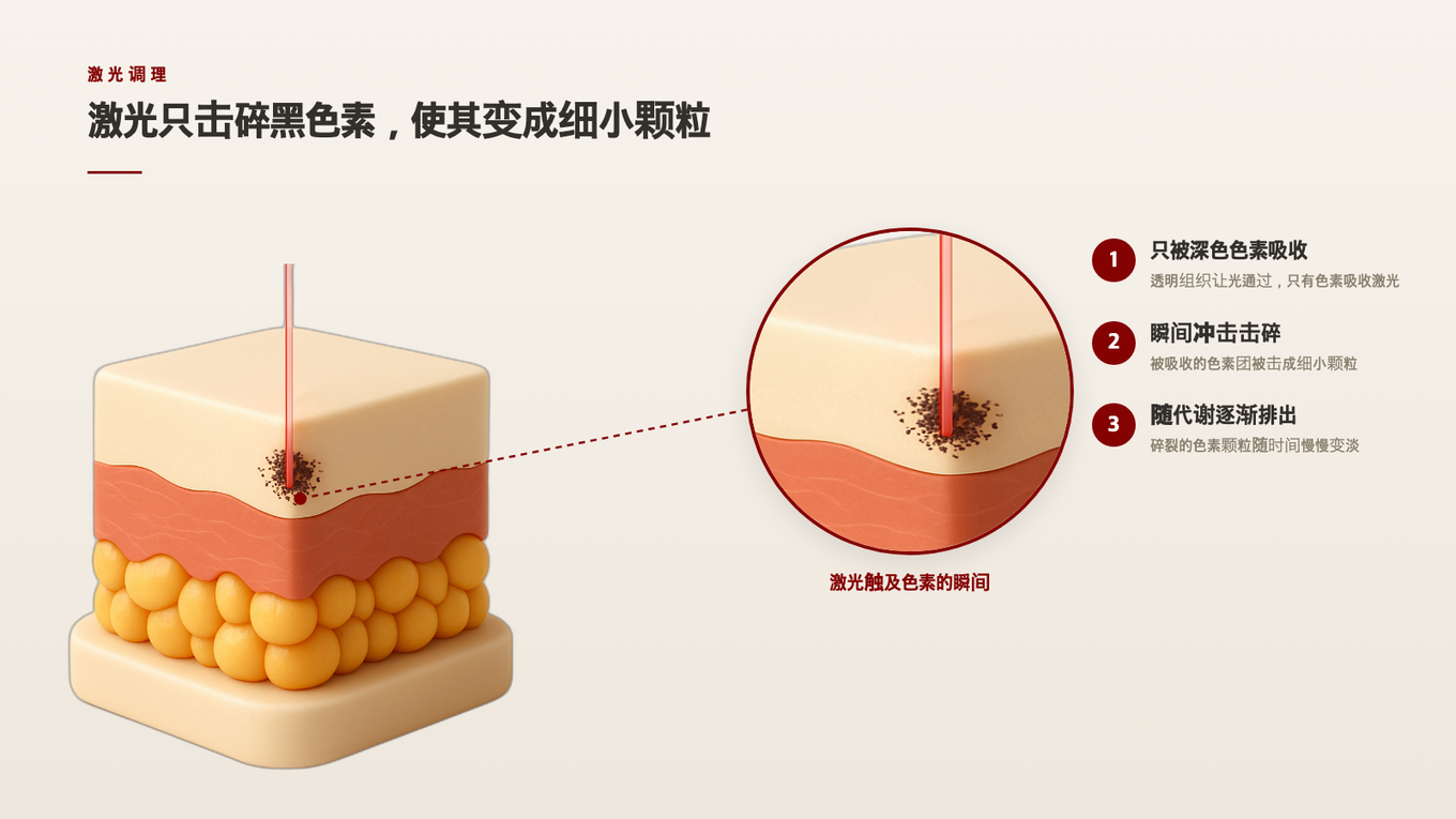 激光光束穿透透明组织并被浓密黑色素团吸收进行粉碎的过程的真实3D截面模型