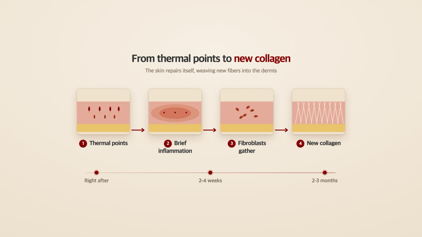 Once thermal coagulation points form, fibroblasts gather and weave new collagen over weeks to months