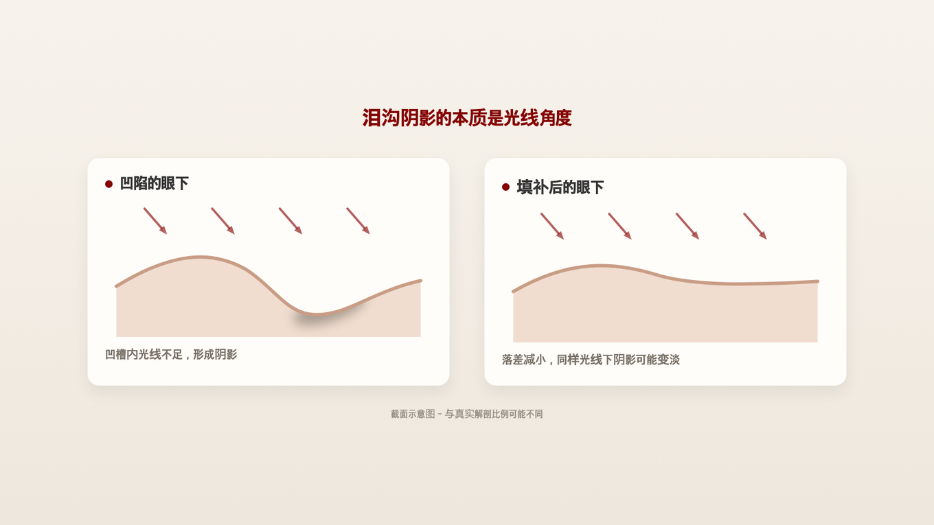 泪沟阴影是由于凹槽光线不足造成的 - 减小凹陷的落差可使同等光照下阴影变淡