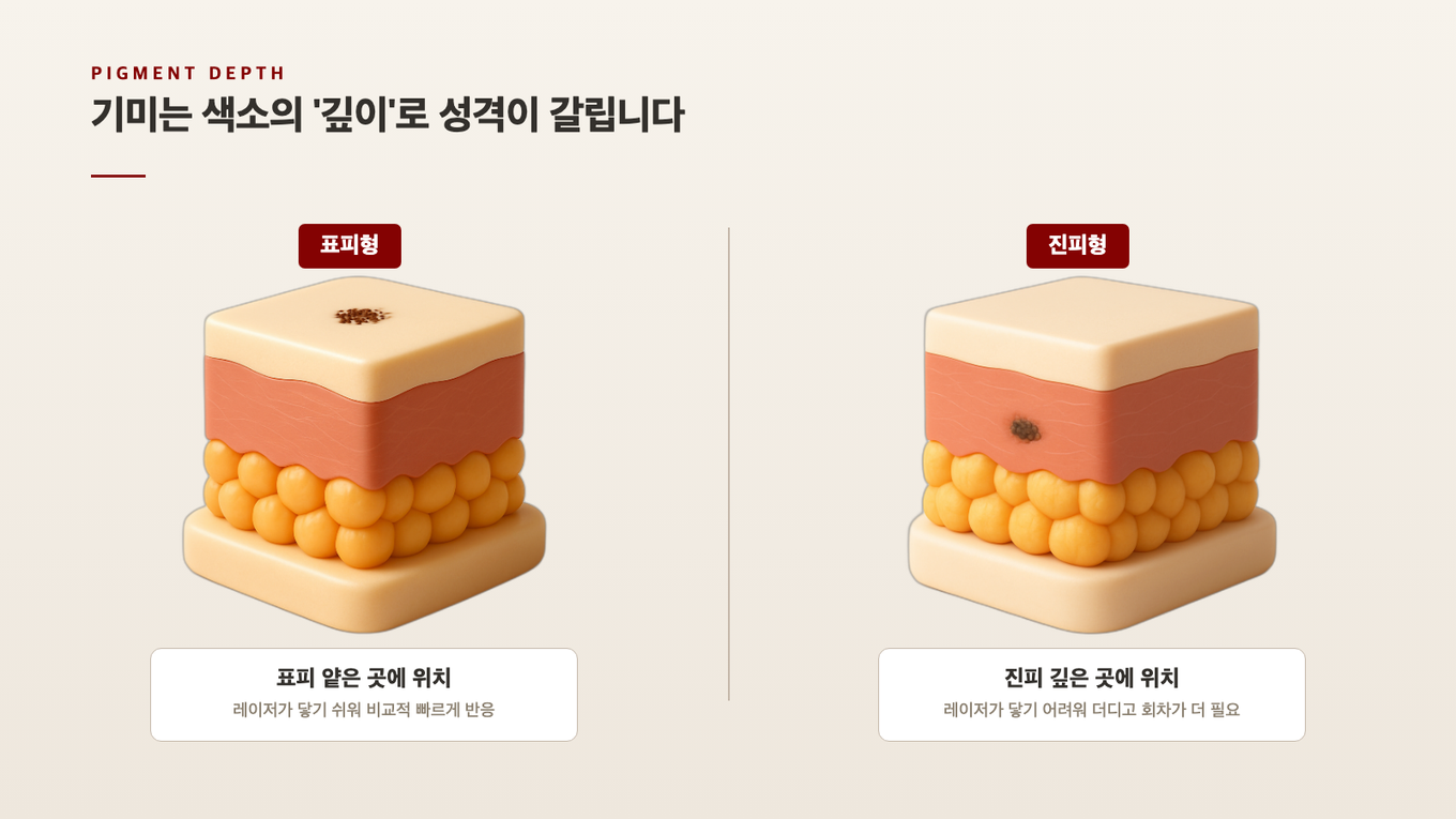 피부 표피와 진피 단면에서 색소가 얕게/깊게 자리 잡은 위치를 보여주는 단면 도식