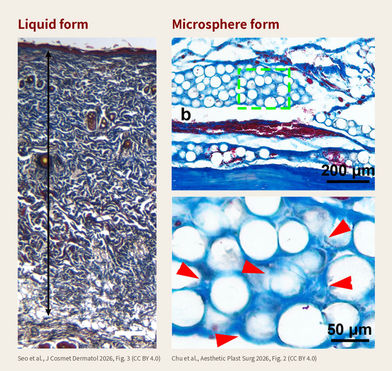 Two published tissue images side by side: on the left, dermis injected with liquid PCL shows no round particles and collagen spread through the dermis; on the right, tissue from a microsphere PCL filler shows clusters of round microspheres with collagen fibers around them