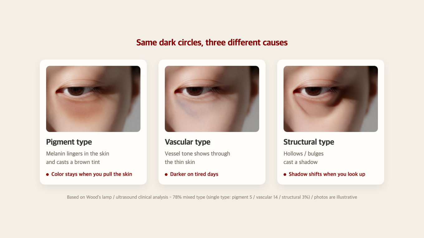 Dark circles can be due to pigmentation, visible blood vessels, or shadows from hollows - 78% are mixed types in clinical studies