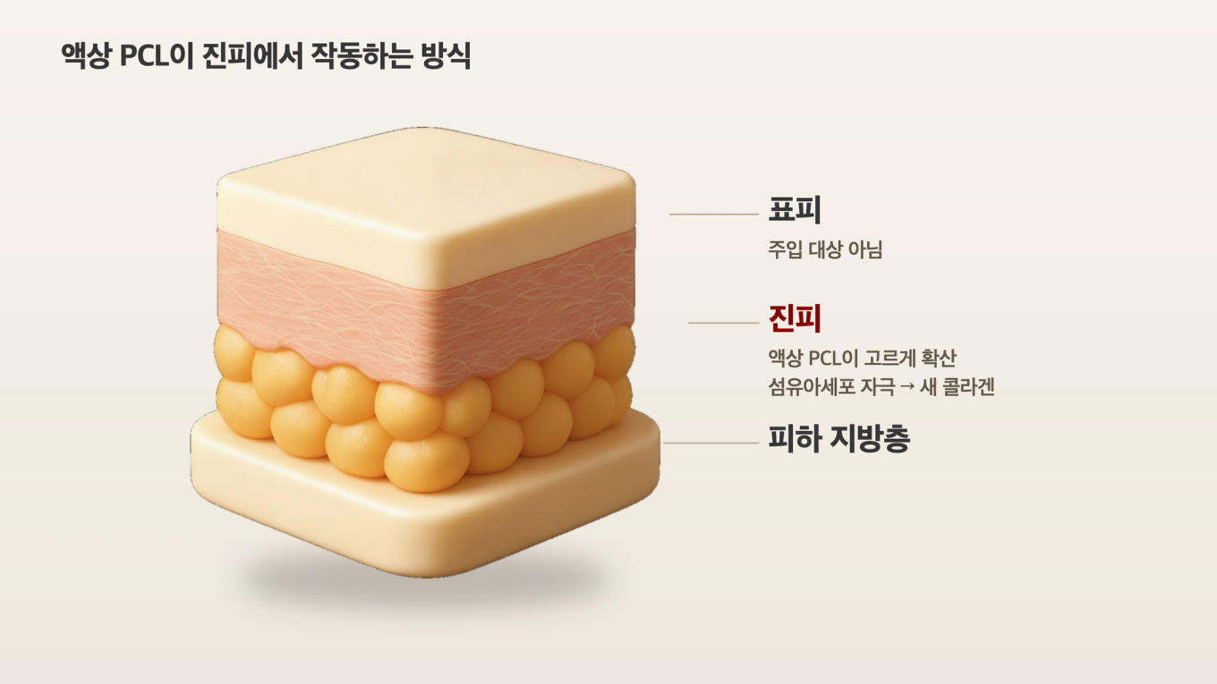 표피와 지방층 사이의 진피 단면 - 액상 PCL이 주입돼 퍼지는 층이다