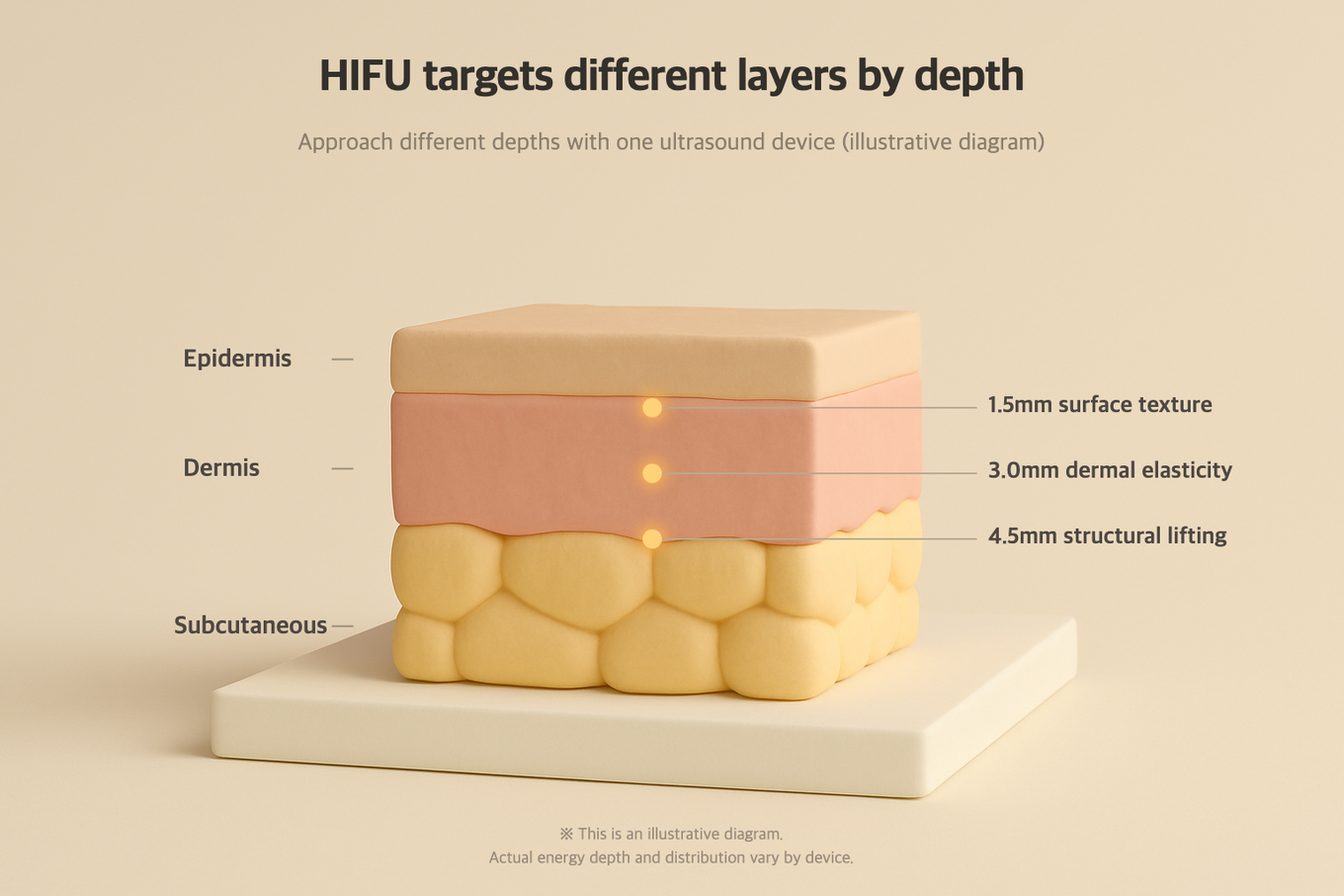 HIFU targets selectable depths of 1.5, 3.0, and 4.5mm, with the deepest 4.5mm reaching the SMAS layer