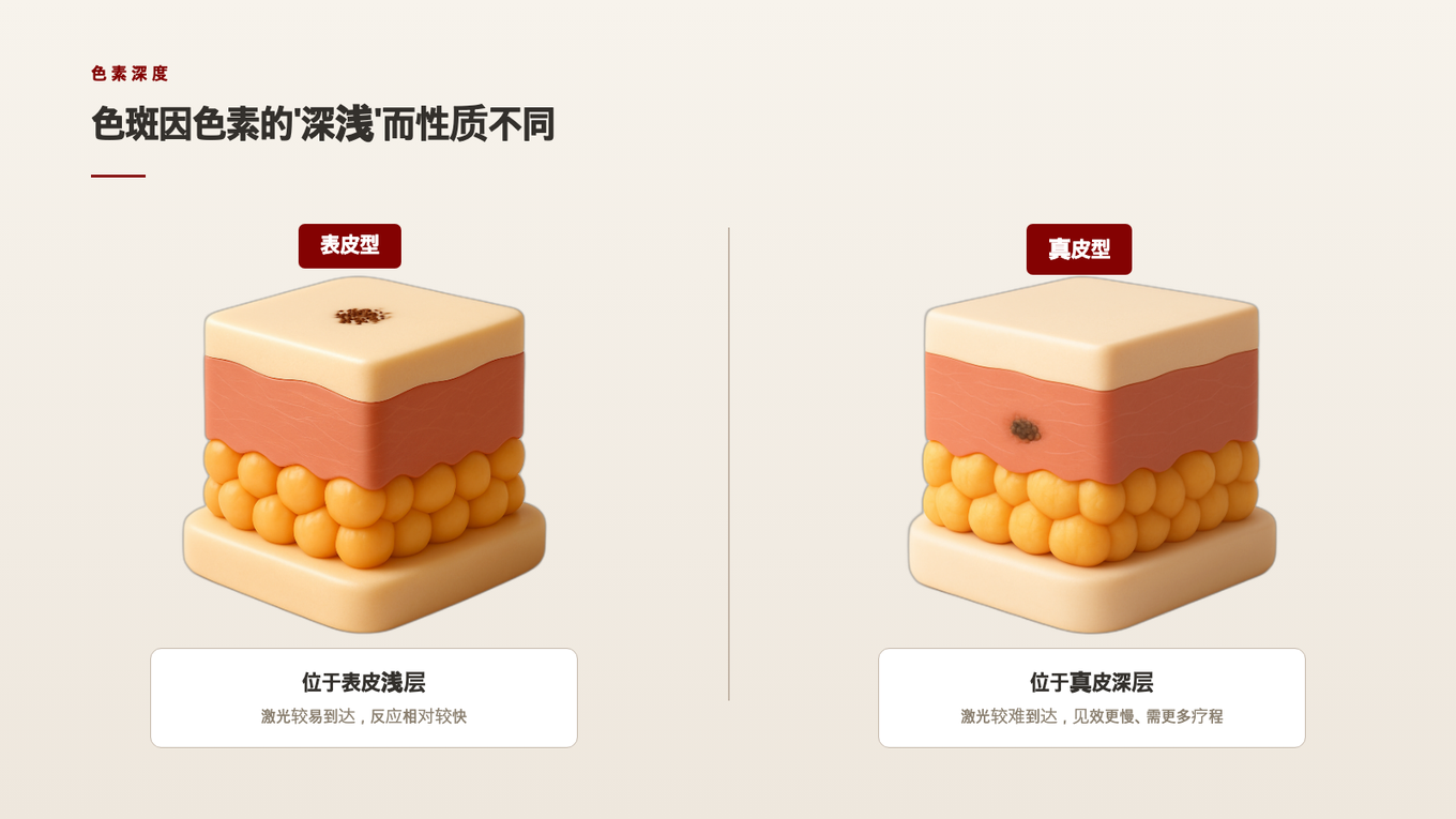 展示皮肤表皮与真皮断面中色素浅层/深层位置的剖面图