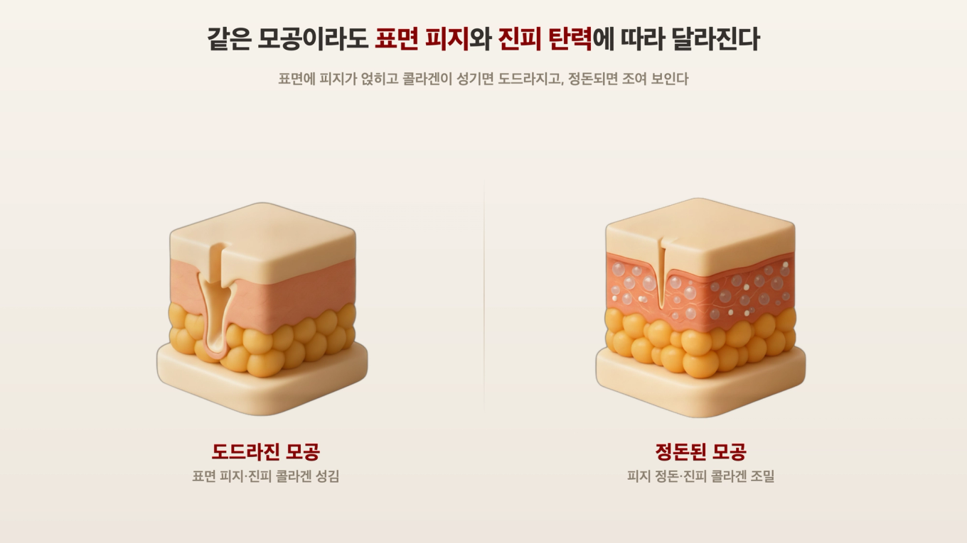 표면부터 넓게 벌어진 모공은 진피 콜라겐이 성기고, 좁게 조여진 모공은 진피 콜라겐이 촘촘하다