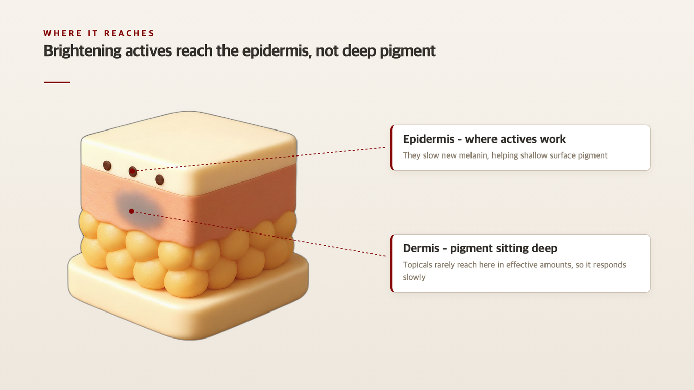 Topical brightening actives reach the epidermis, but they rarely get down to deep dermal pigment in an effective amount