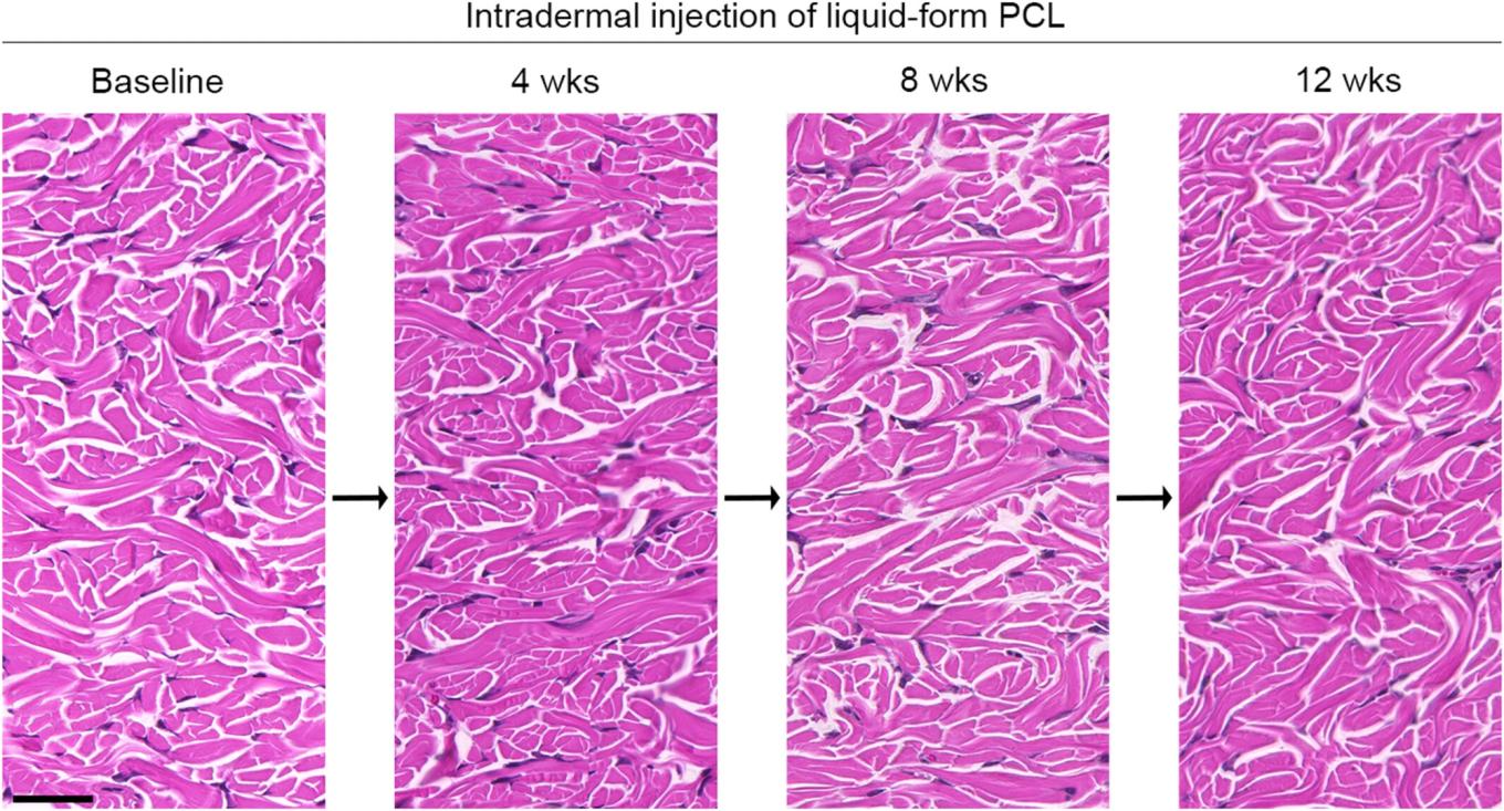 Tissue staining before liquid PCL injection and at 4, 8, and 12 weeks after - no notable inflammation or granuloma findings