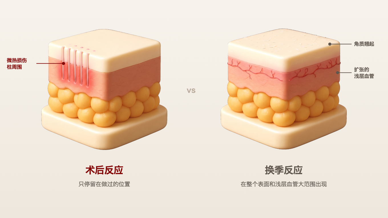 皮肤切面模型：术后反应只在热损伤点周围发红，换季反应在整个表面和浅层血管大范围出现