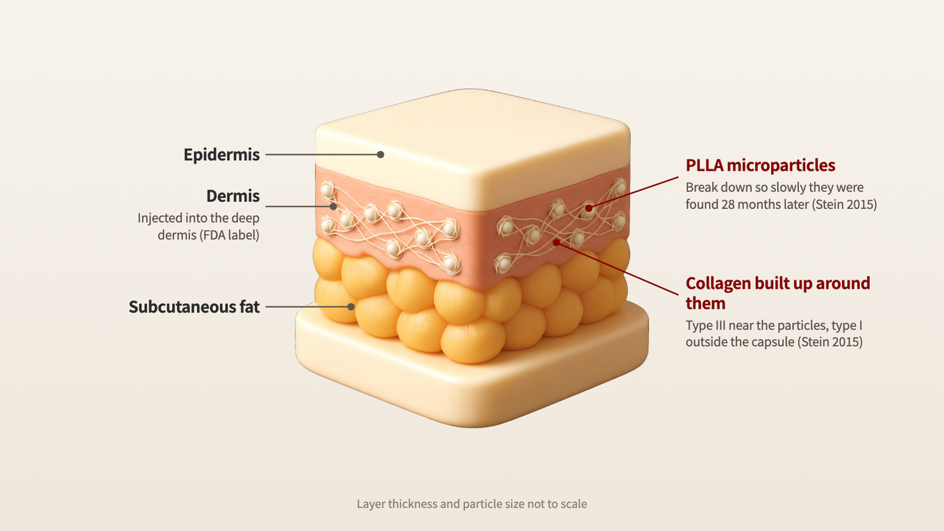 New collagen strands wrap around PLLA microparticles in the deep dermis and weave together