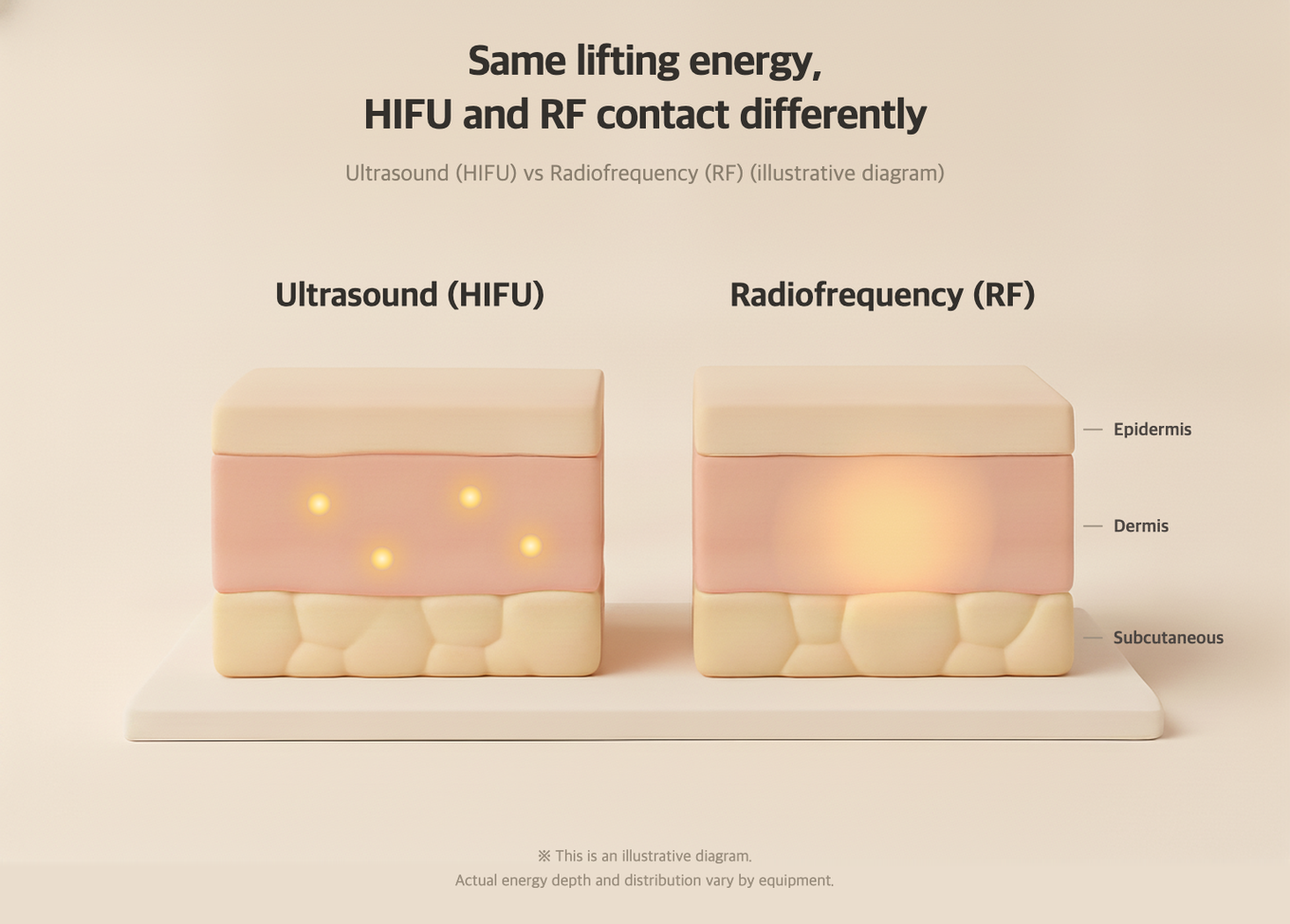 HIFU concentrates energy on a single point to reach deep layers, while RF spreads it across a broad area to heat the dermis evenly