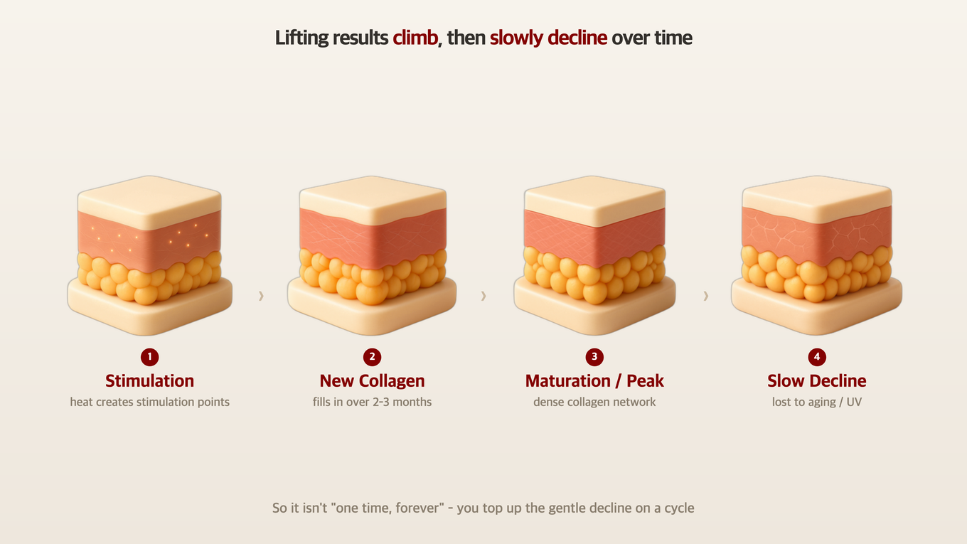 A four-stage skin cross-section 3D model showing collagen being stimulated, regenerated, maturing, then slowly declining with aging after a lifting treatment