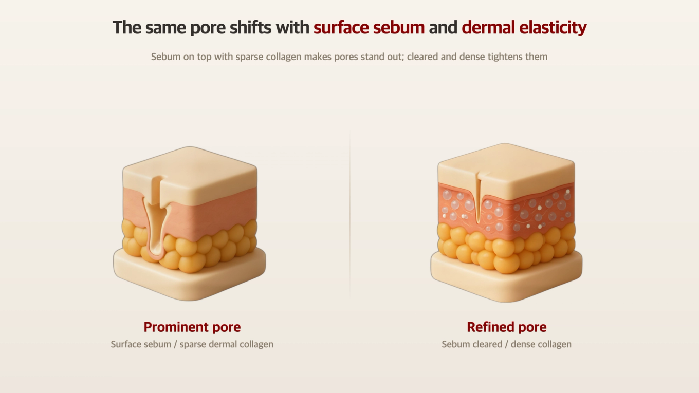 Pores that spread wide at the surface come with sparse dermal collagen, while tight, refined pores sit over dense collagen