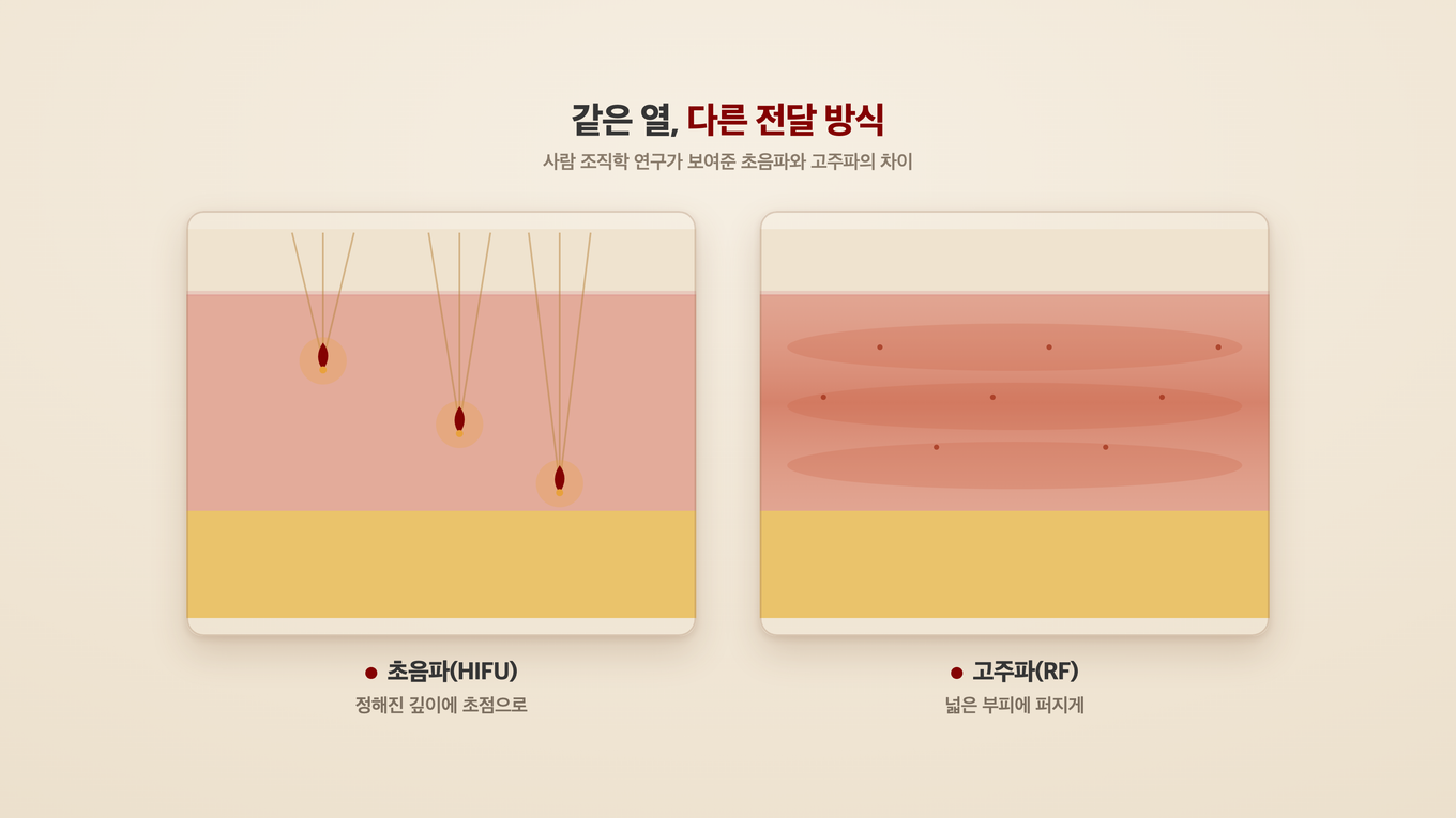 초음파는 정해진 깊이에 초점으로, 고주파는 넓은 부피에 퍼지게 열을 전달한다
