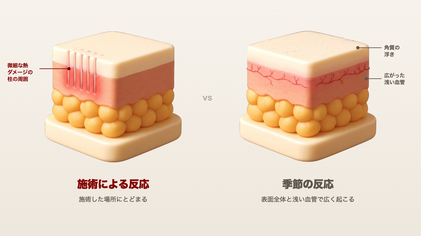 施術による反応は熱ダメージの周囲だけが赤く、季節の反応は表面全体と浅い血管で広く起こることを示す皮膚断面モデル