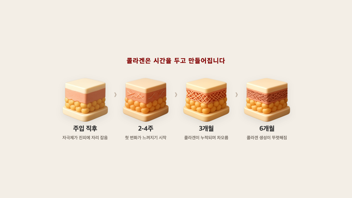 주입 직후부터 6개월까지 콜라겐이 시간을 두고 단계적으로 차오르는 진피 단면 4단계
