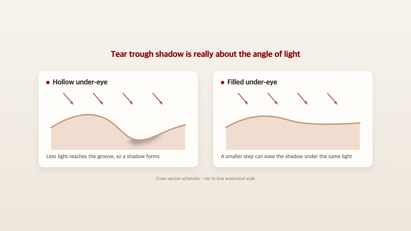 Tear trough shadows occur because light doesn't reach the hollow - reducing the depth can lessen shadows under the same lighting