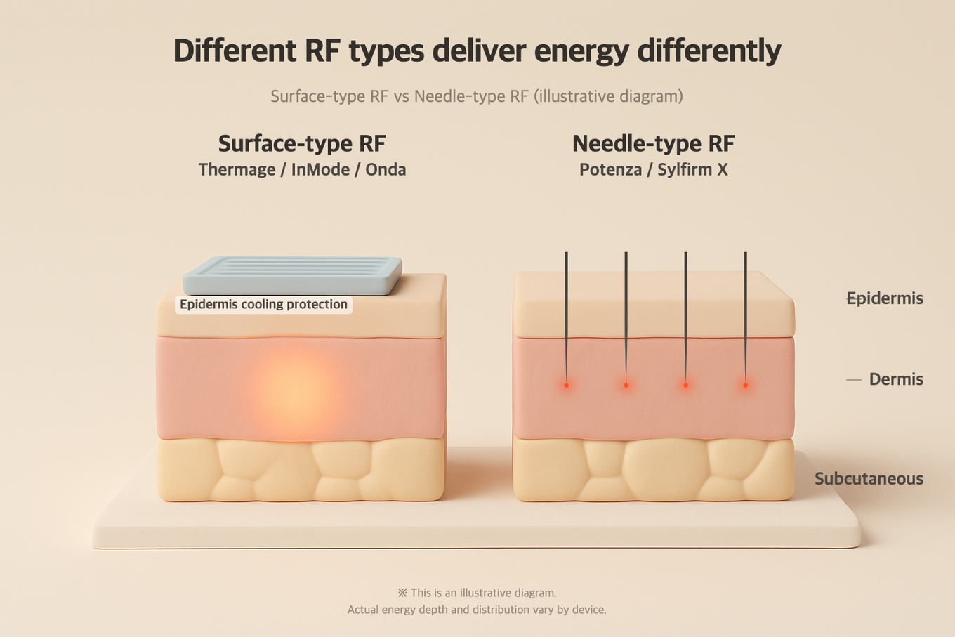 Even within RF, surface-heating devices like Thermage and micro-needle types deliver energy in different ways
