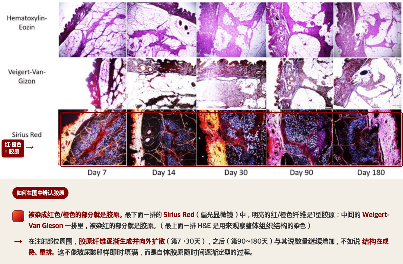 注入聚乳酸（PLLA）胶原刺激剂的皮肤组织，在第7、14、30、90、180天取样的组织学照片 - 最下排Sirius Red染色里发出红/橙光的部分就是新生成的胶原，随时间在注射部位周围逐渐扩散