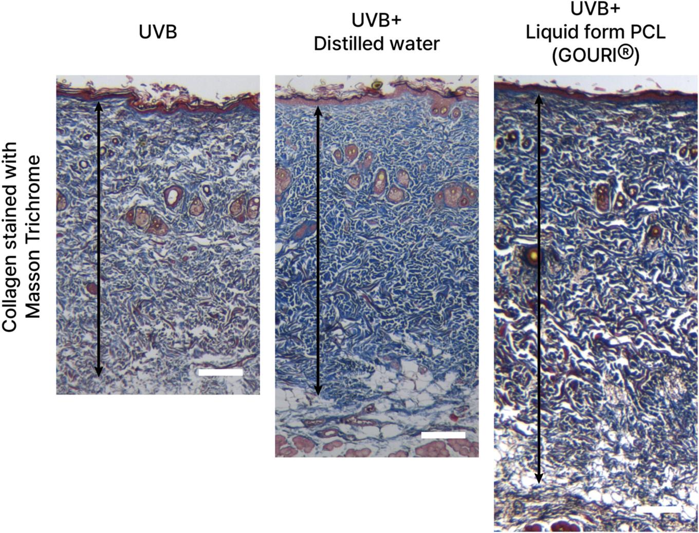 Masson's trichrome staining of dermal tissue from three groups - compared with untreated photoaging and distilled-water injection, the dermis in the liquid PCL group is thicker and its collagen denser