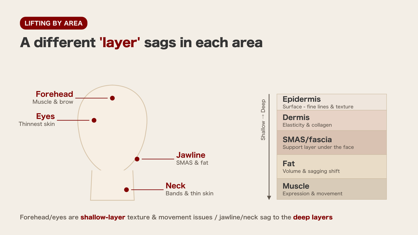 Forehead and eyes involve shallow layers, jawline and neck involve deep support layers like SMAS, so each area has different problematic skin layers
