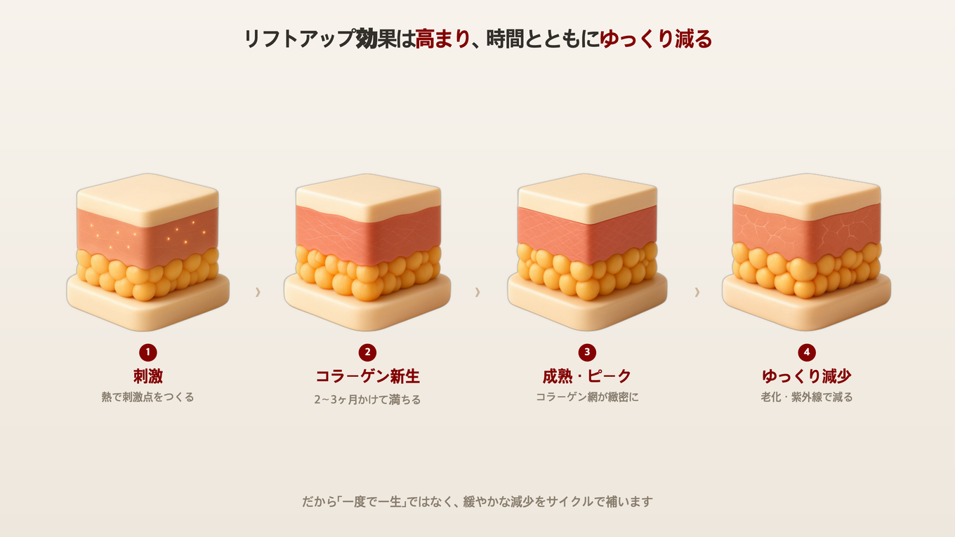 リフトアップの刺激後、コラーゲンが新生・成熟し、その後の老化で少しずつ減っていく過程を、肌の断面3Dモデルで4段階に示した図