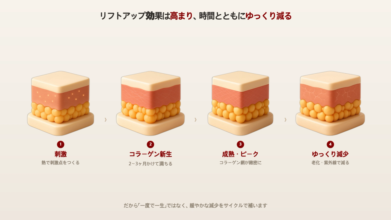 リフトアップの刺激後、コラーゲンが新生・成熟し、その後の老化で少しずつ減っていく過程を、肌の断面3Dモデルで4段階に示した図