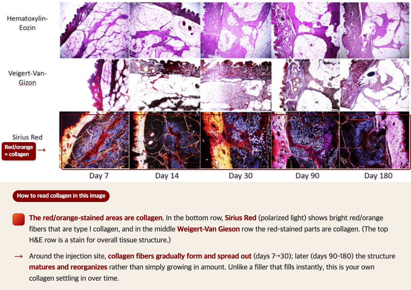 Histology of skin injected with a poly-L-lactic acid (PLLA) collagen stimulator, biopsied at days 7, 14, 30, 90 and 180 - in the bottom Sirius Red row, the red and orange glow is newly formed collagen, spreading outward around the injection site over time