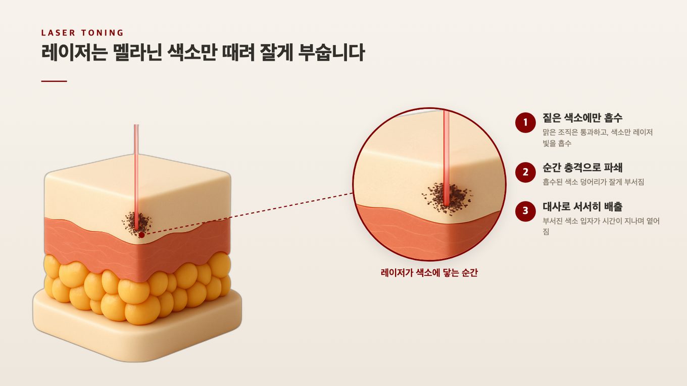 레이저 빛이 맑은 조직은 통과하고 짙은 멜라닌 색소 덩어리에만 흡수돼 잘게 부수는 과정을 표현한 사실적 3D 단면 모형